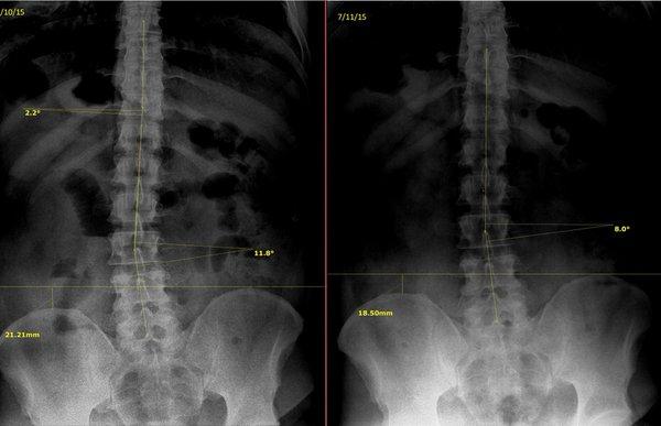 We specialize in spinal correction!