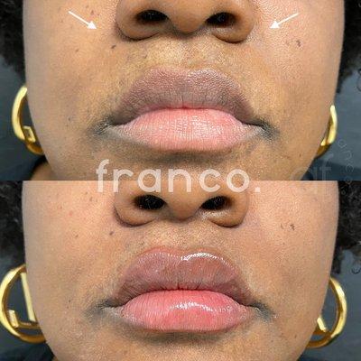 Lip Filler & Nasolabial Folds