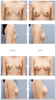 Breast Augmentation