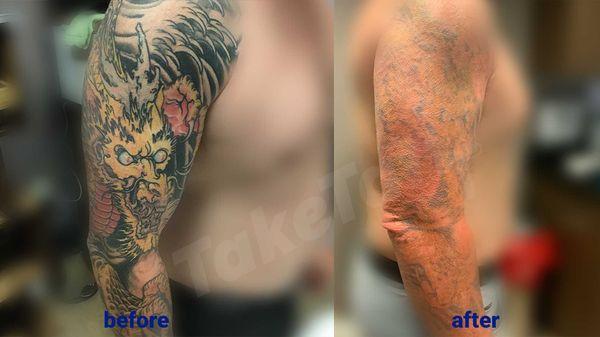 TakeTatt Tattoo Removal