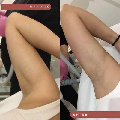 arm fat reduction, arm sculpting treatment