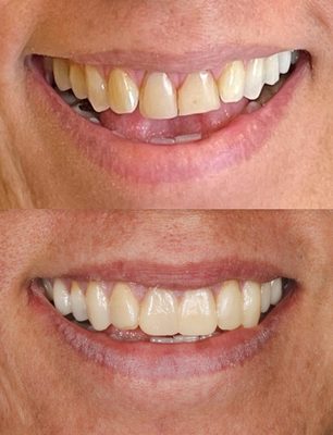 Before and after veneers.