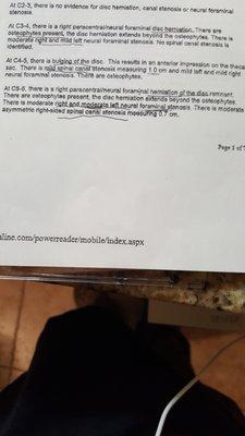 Post 2 Level ACDF. Really do NOT think moderate stenosis in the surgical levels should be in a post surgery MRI. Post-op report says all goo