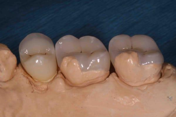 Modern Conservative Dental options, Inlay/Onlay