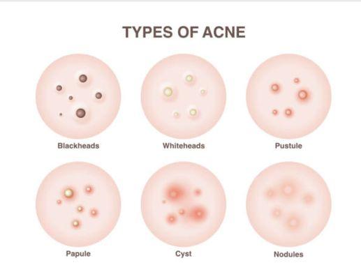 different types of acne!