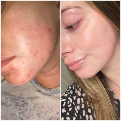 Left is 2 weeks before starting isotretinoin, right is after