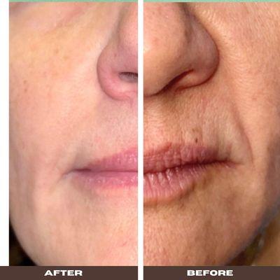 FIBROBLAST SKIN TIGHTENING