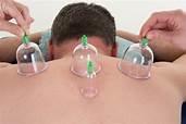 Cupping