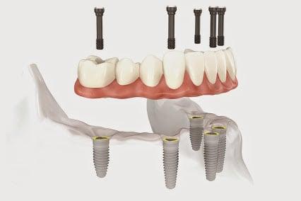 Dental Implant Dentures