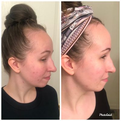 Client acne progress