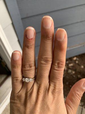 Bleeding nails from nail technicians aggressive behavior. The other hand has two sore fingers.