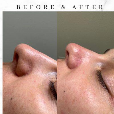 Deep pore facial