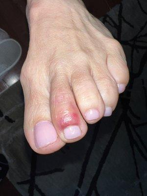 Infected toe nail