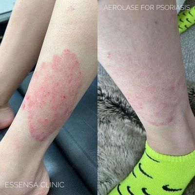 Aerolase Laser aczema / psoriasis treatment before and after starting at $899 (up to 4 treatment package).