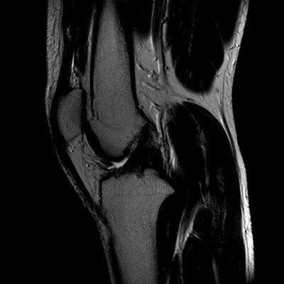 mri of the knee