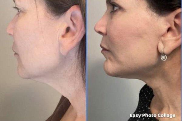 Neck lift before and after (day 13)