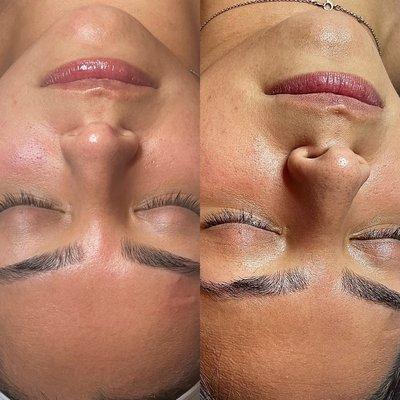 Facial before and after