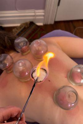 Releasing tension, warming the meridians with fire cupping.