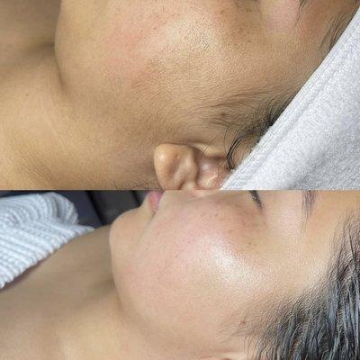 Before and after of a Dermaplaning Facial