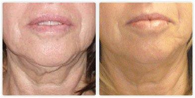 Exilis Ultra Neck Tightening - Results Like Never Before!