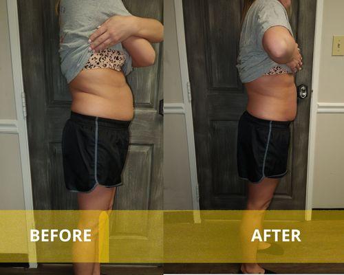 Before and after lipo Cavitation and wood therapy treatment.