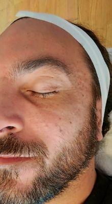 Close up of skin texture after 1 basic facial