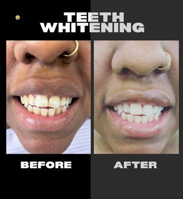 Teeth whitening