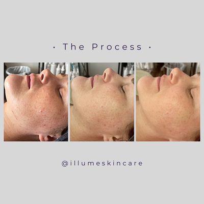 Skin improvement over a few months visiting Illume skincare