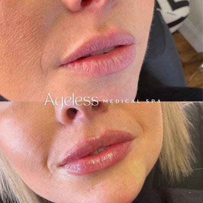 Ageless Lip Filler Results