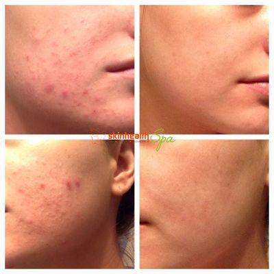 Don't let acne affect your skincare confidence!