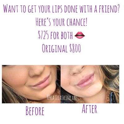 Lip Fillers done by Dr. Maria Chirino