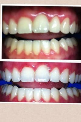 before & after: 30 minute in office whitening