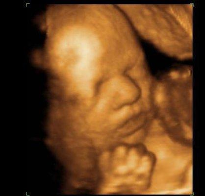 4D ultrasound, precious!