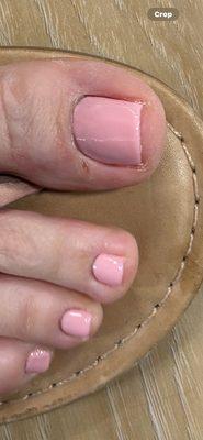 Blistered toe