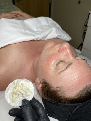 Dermaplane facial glow!