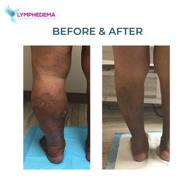 Lymphedema Treatment Results