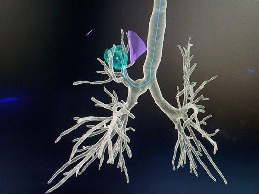 Robotic Bronchoscopy