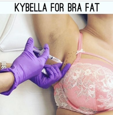 Bra Fat, Banana roll, Abdomen Fat. Try Kybella