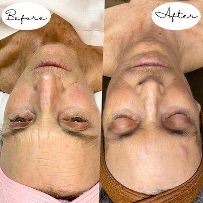 Before and after a series of cosmetic facial acupuncture and microneedling treatments. The client is half way through her treatment series.