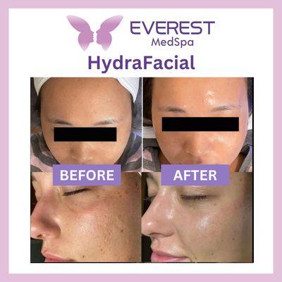 More before and after photos. After 1 hydrafacial!