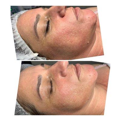 Acne scar  microneedling treatment