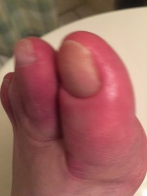 Infected toes