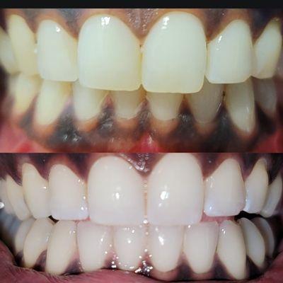 Results after a 1 hour teeth whitening session.