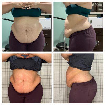 Use CryoSculpting on your stomach to help tighten skin!