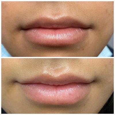 Natural lip enhancement before and after