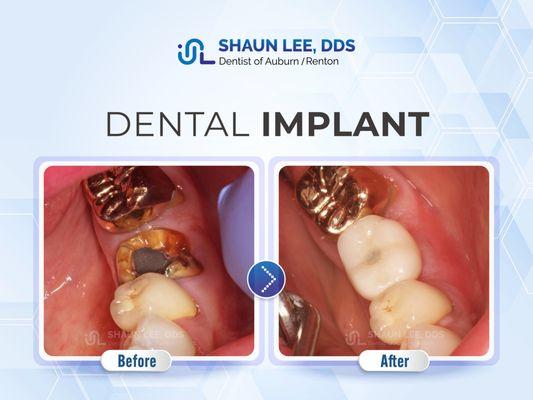 Shaun Lee, DDS Family Emergency Dental Implants of Auburn | 1320 8th St NE Ste. 103, Auburn, WA 98002 |(253)939-3440