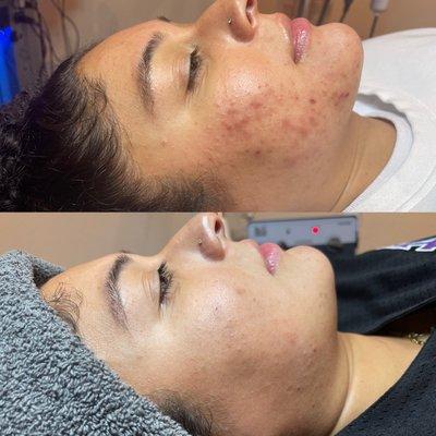 Acne scars and non-inflamed acne.