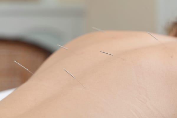 Acupuncture involves thin needles inserted into the body at acupuncture points to promote "Qi" and blood circulation