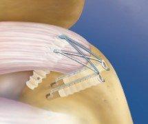 A "double row" rotator cuff repair can improve healing rates and restore function.