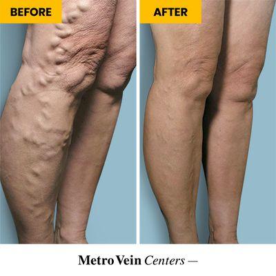 Before and after: varicose vein removal results. We offer a variety of varicose vein treatments, done in under 15 minutes!